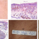 Melanocytic lesions ≤ 6mm