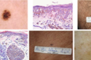 Melanocytic lesions ≤ 6mm